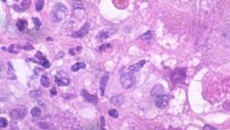 Hepatitis D Virus Signs, Symptoms, Treatments