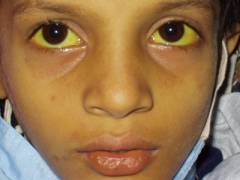 Hepatitis Virus Types, Information Hepatitis Virus Types, Information